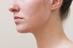 Comment se débarrasser de l'acné flambées soudaines